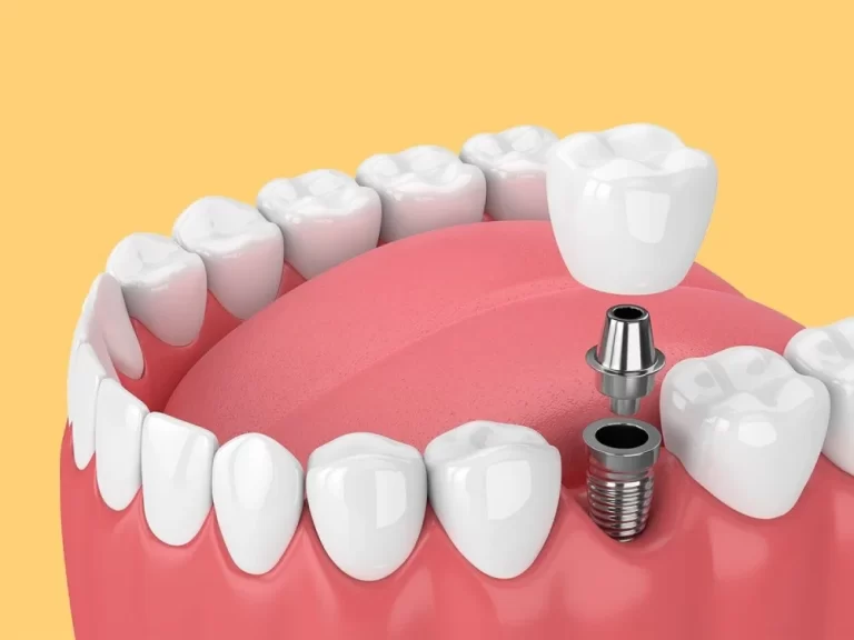 Two implants abutments are virgin teeth